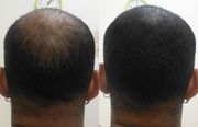   SMP for Balding Men|Need a Head Tattoo