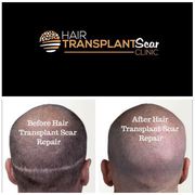 Hair Transplant Scar Repair